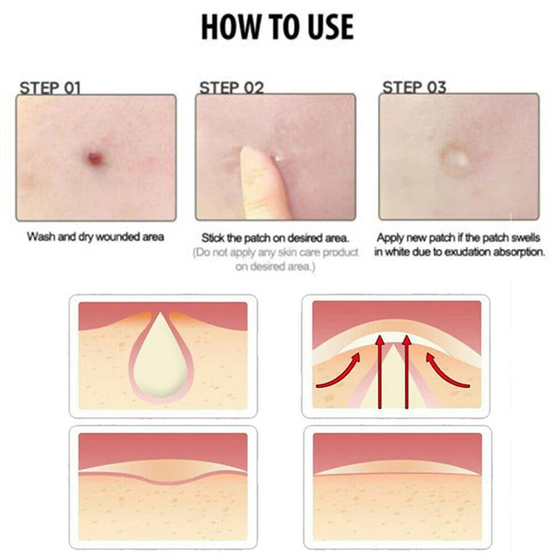 Acne Patch Skin Tags Beauty Set Remover Pimple Master Patch Treatment skin tag removal black head remover tool acne remover